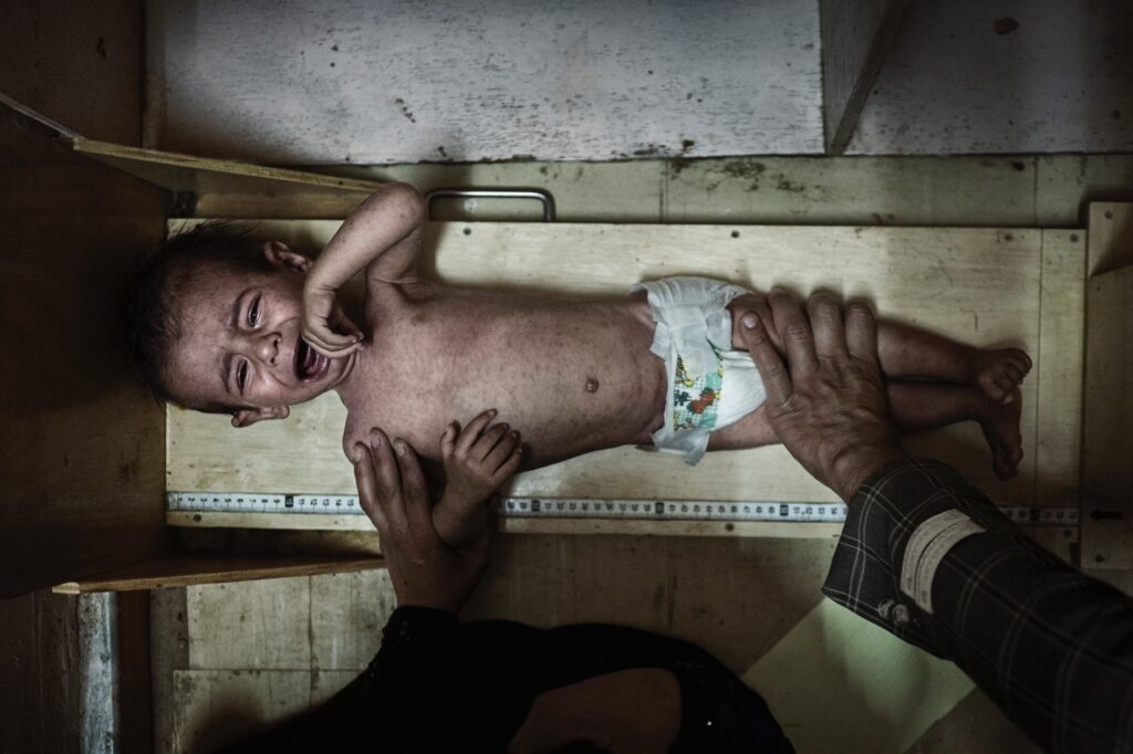 Every ten minutes a child under the age of five dies in Yemen, according to the UN. Luckily Said is still alive. He’s nine months old and is being measured by the doctors at the triage unit at the Al-Jumhuri Hospital in Saada. He is 68 centimeters long and weighs 5,6 kilos. According to his doctor, dr. Ali Al-Gamadis, the boy should weigh twice that, and he is in serious need of medical attention. Said’s father, Minar Msfar Salem, has pawned his mobile phone to get the last money to pay for one day of treatment for his son. The bill amounts to 3,000 Yemen Rial or roughly ten and a half euros. Fotograf: Rasmus Flindt Pedersen